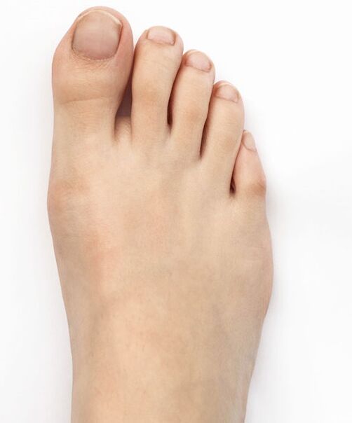 Nire thumb valgus sendatu nuen Hondro Sol Valgus sprayarekin