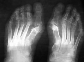 Oinaren Valgus azpian eragiketen adierazpenak