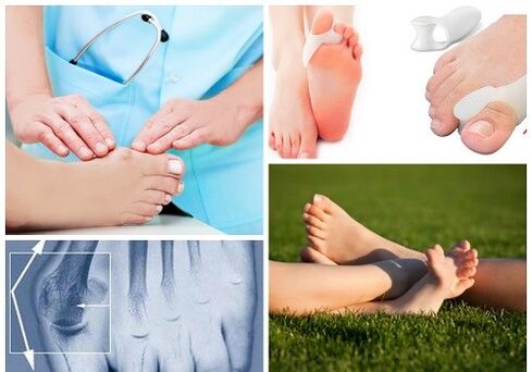 Valgus deformazioaren tratamendua