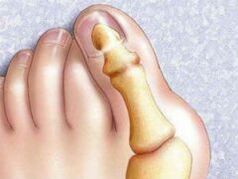 Hallux Valgus deformazioa