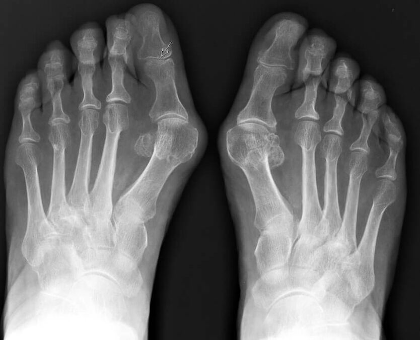 Hallux valgus-aren erradiografia