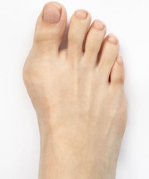 hallux valgus erabili aurretik Hondro Sol Valgus spray